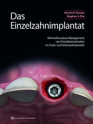 Das Einzelzahnimplantat